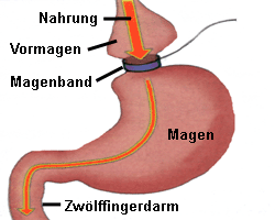 Magenband